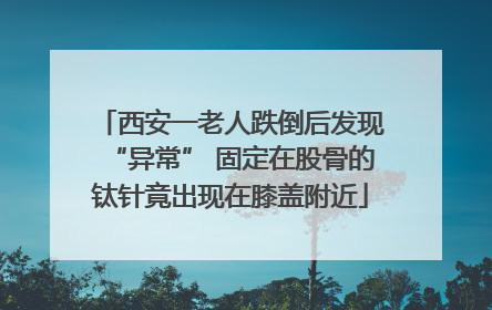 西安一老人跌倒后发现“异常” 固定在股骨的钛针竟出现在膝盖附近
